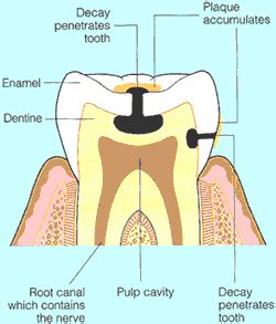 Any pain and sensitivity you experience should be resolved within a few days or weeks. What does a dental hygienist do? Including dental hygiene ...