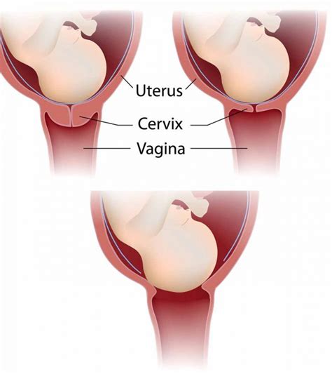 Feb 03, 2021 · preparing to check your cervix manually 1. What Happens To Your Cervix During Birth Or Labor?