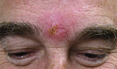 The majority of recurrent oral herpes cases are caused by herpes simplex virus type 1. Granulomatous rosacea manifesting after herpes simplex 2 ...