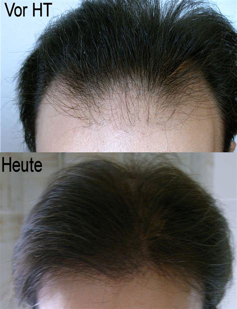 Divaderme brow extender vorher nachher testbericht. Haarausfall - Allgemeines Forum : Haare und Haarausfall ...