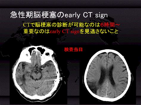 ●主な検査 頭部ct：脳出血や脳腫瘍の発見に役立ちます。 通常は当日施行できます。 頭部mri：脳梗塞や脳の細かい異常の検出に有用です。 潜因性脳梗塞（原因不明の脳梗塞）の診断. 循研：CITEC 臨床情報講座 CT-Ⅲ 頭部CT検査でわかること