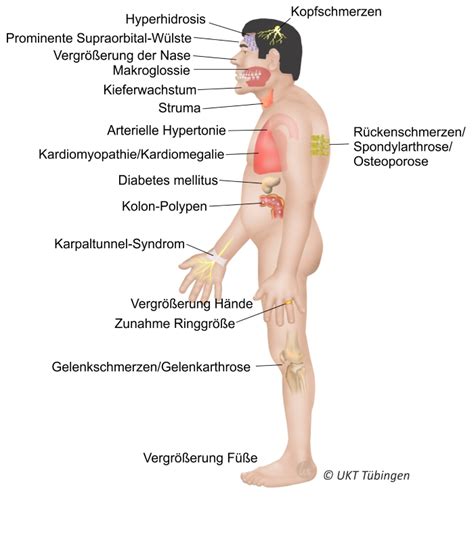 Das vollmondgesicht1 (auch mondgesicht, lat. Tumoren der Hypophyse / Uniklinik Tübingen Neurochirurgie