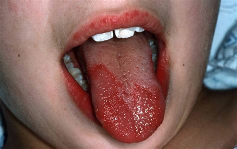 Geographic Tongue - Causes, Symptoms & Treatment