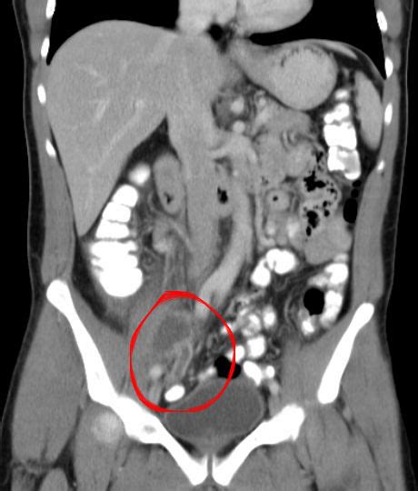 Definisi apendisitis akut adalah penyebab paling umum inflamasi akut pada kuadran bawah kanan rongga abdomen, penyebab paling umum untuk bedah. Diagnosis Abses Apendiks - Alomedika