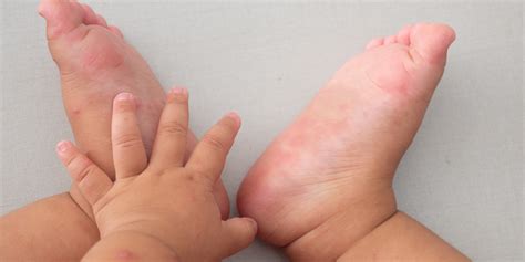 Hand, foot and mouth disease starts with blisters that begin as small red dots which later become ulcers. Hand foot and mouth cure - NISHIOHMIYA-GOLF.COM