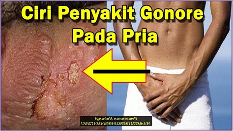 Penyakit ini lebih sering terjadi pada wanita dan bukan penyakit yang menular. Cara Mengetahui Ciri Penyakit Gonore Pada Pria - YouTube