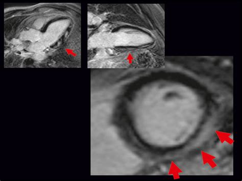 La miocarditis es la inflamación local o general del músculo del corazón (miocardio). Miocarditis - Sociedad Española de Cardiología