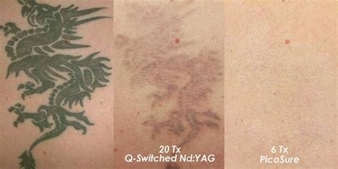 In a laser treatment highly concentrated light passed through your skin and focused on tattoo the leaser treatment is expensive tattoo removal method and it also painful process to remove the tattoo. PicoSure Laser Tattoo Removal