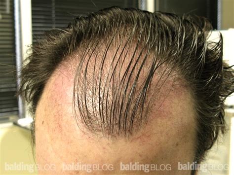 You might not instantly get rid of their existence after the surgery. Scabs After Hair Transplant (with Photos) | WRassman,M.D ...