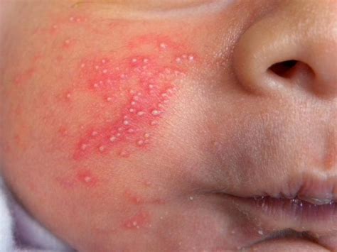 A burning sensation is often present just before the skin. cluster of small bumps on skin - pictures, photos