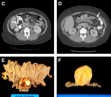 Colic intussusception — colonic intussusception intussusception involving two segments of the colon … medical dictionary. Electronic Clinical Challenges and Images in GI - Gastroenterology