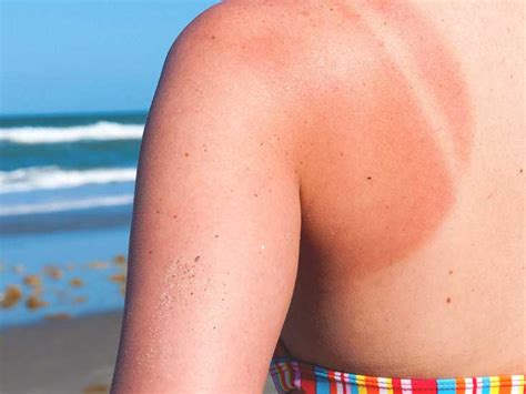 For others, shingles can cause intense pain that can be felt from the gentlest touch or. How Long Does a Sunburn Last?