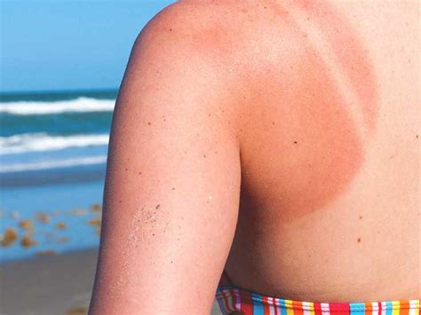 It depends on how many blisters you have and how you take care of them. How Long Does a Sunburn Last?