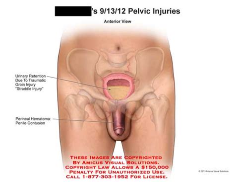 Those suffering from severe pull might need medical attention. AMICUS Illustration of amicus,injury,pelvic,urinary ...