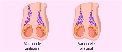 Varicoceles are common and usually form during puberty. Varicocele bilateral o unilateral