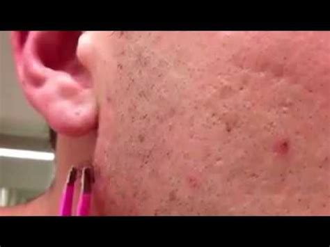 Vellus hair serves a purpose, which is to help regulate our body temperature. The longest Ingrown Hair Removal - YouTube