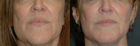 The final cost of your treatment also depends on whether you pursue additional nonsurgical treatment, such as microdermabrasion and juvéderm. How Much Does Laser Skin Resurfacing Cost? | Winter Park ...
