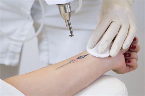 Two locations in austin, texas. Laser Tattoo Removal | Rejuvene MD Laser Tattoo Removal El ...