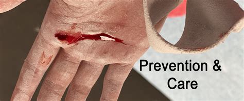 Protect all blisters from further irritation by covering. Gymnastic Planet Tips to Prevent and Treat Gymnastics ...