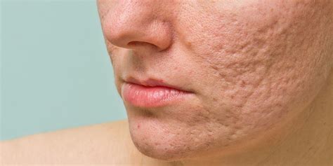 Wide scars can often be made thinner. How to Get Rid of Acne Scars - A Full Breakdown - Apex ...