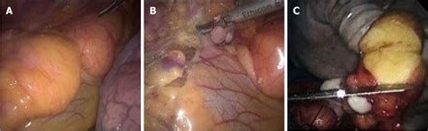 Es liegt in der medianebene zwischen den beiden. Pleomorphic lipoma in the anterior mediastinum: A case report