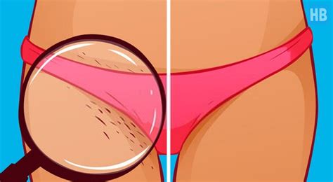 Ingrown hairs can be very similar to pimples and cysts—they can all form around hairs and be bumps or lumps, jules lipoff, m.d., assistant professor of clinical dermatology in the. Oh No! Bad Ingrown Hairs After Brazilian Wax: What To Do?