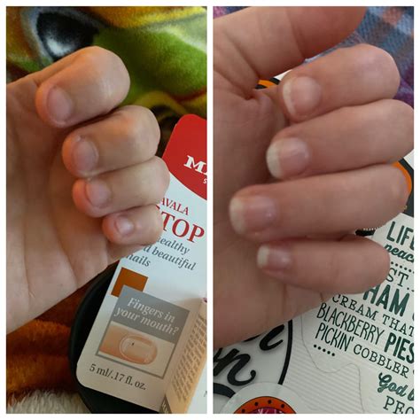 How to stop nail biting in a child. A 33-Year Old's Journey to Stop Biting My Nails