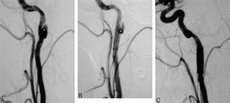 A stroke can also occur if plaque in your artery is dislodged when the catheters are being threaded through the blood vessels. Angioplasty and Stenting in Carotid Dissection with or ...