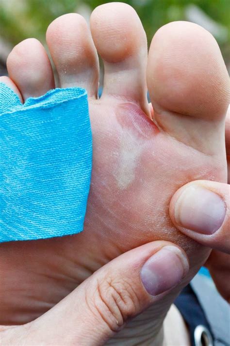 · having a blister on your hand is annoyingly painful. Should you pop a blister? When to do it, safe methods, and ...