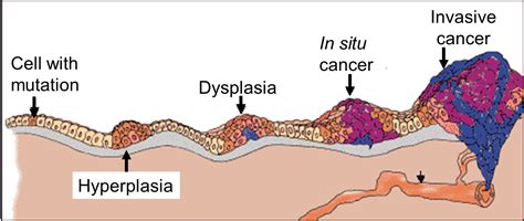 Carcinoma in situ ( cis ) is a group of abnormal cells. Evolution of a Cancer