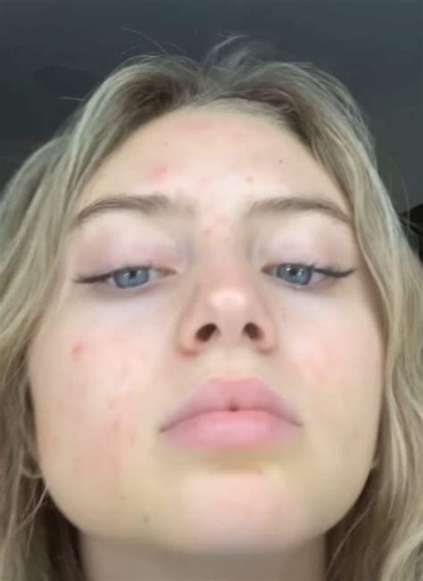 Leni, who has covered magazines such as glamor germany and vogue germany in her mother's homeland, is heidi's firstborn. Beauty-Probleme: Stars mit unreiner Haut | GALA.de