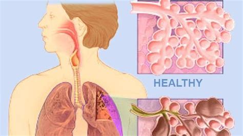 Tuberkulosis alias tb atau tbc adalah penyakit yang disebabkan oleh bakteri mycobacterium tuberculosis. Cara Mengatasi Paru Obstruktif Kronis Yang Alami