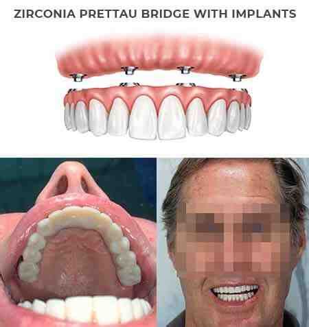 Getting a dental implant is an intensive treatment that requires. How Much Does It Cost For A Full Set Of Dental Implants ...