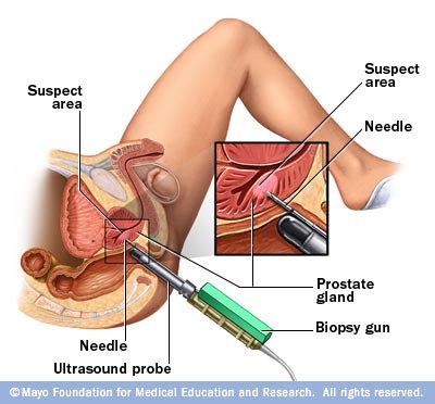 If signs are pointing to prostate cancer, tests will be done. An Unexpected Error: You've been diagnosed with prostate ...