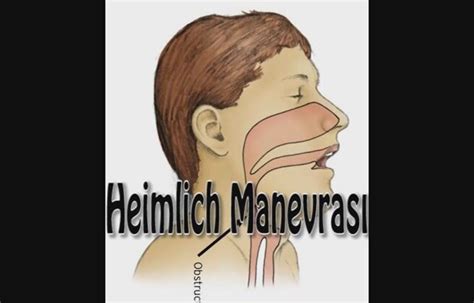 Heimlich manevrası 2 şekilde uygulanır. Heimlich Manevrası Nasıl Uygulanır? | İzlesene.com