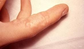 This bump can appear either on the sides, on the tip, on top of the finger or inside the palm. Health and Fitness: The Blister on the Finger