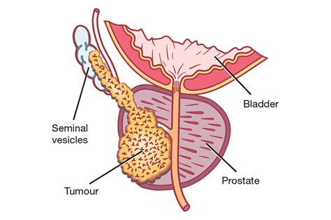 Your doctor will take a detailed history and physical examination to order the appropriate workup, and will. A Guide to Prostate Cancer | Urology Specialist