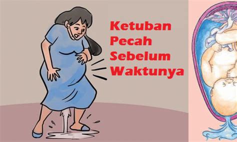 Komplikasi yang boleh berlaku termasuk jangkitan, gangguan uri (uri tertanggal sebelum. Ketuban Pecah Dini