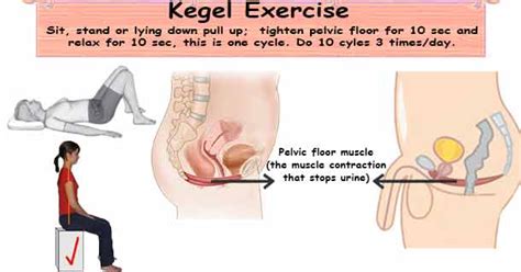 Use this nursing diagnosis guide to formulate your constipation nursing care plan. Exercise for Constipation! Kegel Exercise