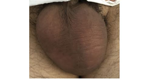 The swelling or lump can be about the size of a pea but may be larger. VIETNAMESE MEDIC ULTRASOUND: CASE 599: TESTICULAR CANCER ...