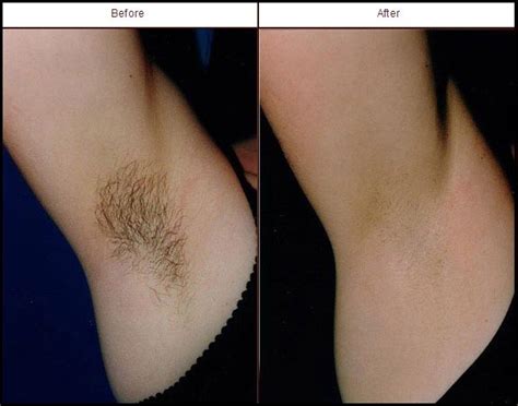 What's the real price you'd pay for smooth skin? Say goodbye to hairy underarms! Schedule an appointment ...