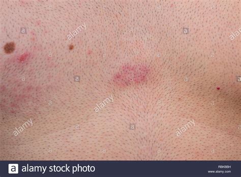 Acyclovir treatment is best started within 72 hours of symptom onset (ie, rash, blisters, tingling, burning) and most effective if started within 48 hours of symptom onset. Shingles Herpes Zoster High Resolution Stock Photography ...