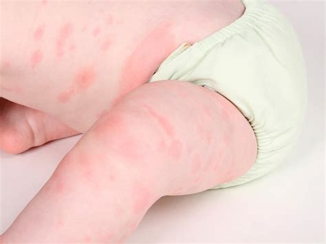 Reddish bumps or wheals · lip and mouth swelling · belly ( . Allergies & Asthma in Babies | BabyCenter