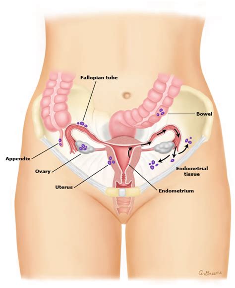 Ovarian hormones also interact with other hormones (pituitary gland hormones) to control the menstrual cycle. Endo what? How endometriosis affects fertility—and how egg ...