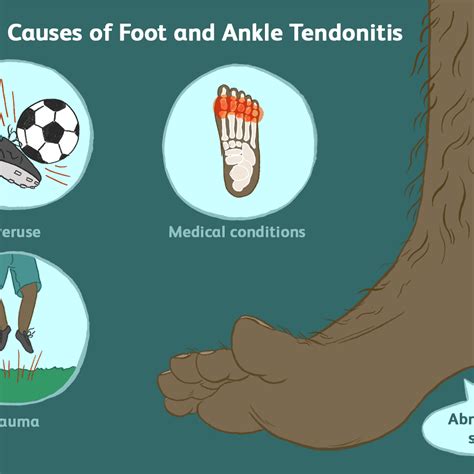 Nov 10, 2020 · the tendon of flexor pollicis longus is surrounded by its own synovial sheath. Left Leg Flexor Tendon Location : Flexor Hallucis Longus ...