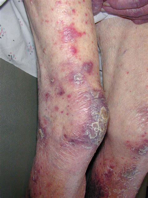 Past treatment for cancer and certain genetic conditions affect the risk of having childhood all. Health Talk: Leukemia: Blood Cancer