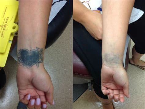 To make an appointment, call our office today. Tattoo Removal Services in Los Angeles - Renee Patel, M.D ...