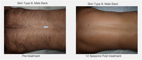 While this doesn't provide permanent hair removal, the treatment will reduce hair growth. Permanent Hair Removal with Medical Grade Machines @ NMC.