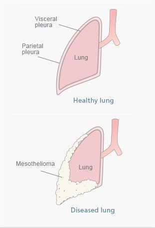 Mesothelioma adalah kanker agresif yang biasanya berasal dari paparan asbes. Mesothelioma, Penyakit Mematikan Akibat Paparan Asbes Ini ...