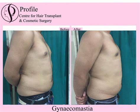 We sit down with dr. How much does gynecomastia surgery costs in India? - Quora